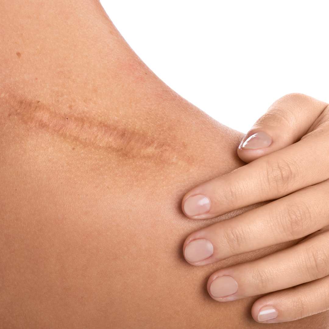 Narben entfernen mit Permanent Make Up 