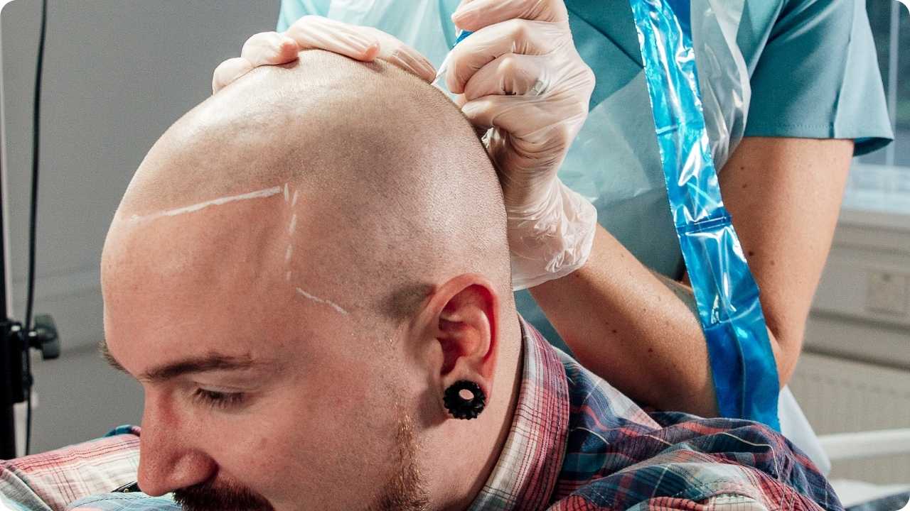SMP Behandlung zur optischen Haarverdichtung im modernen Studio Köln.