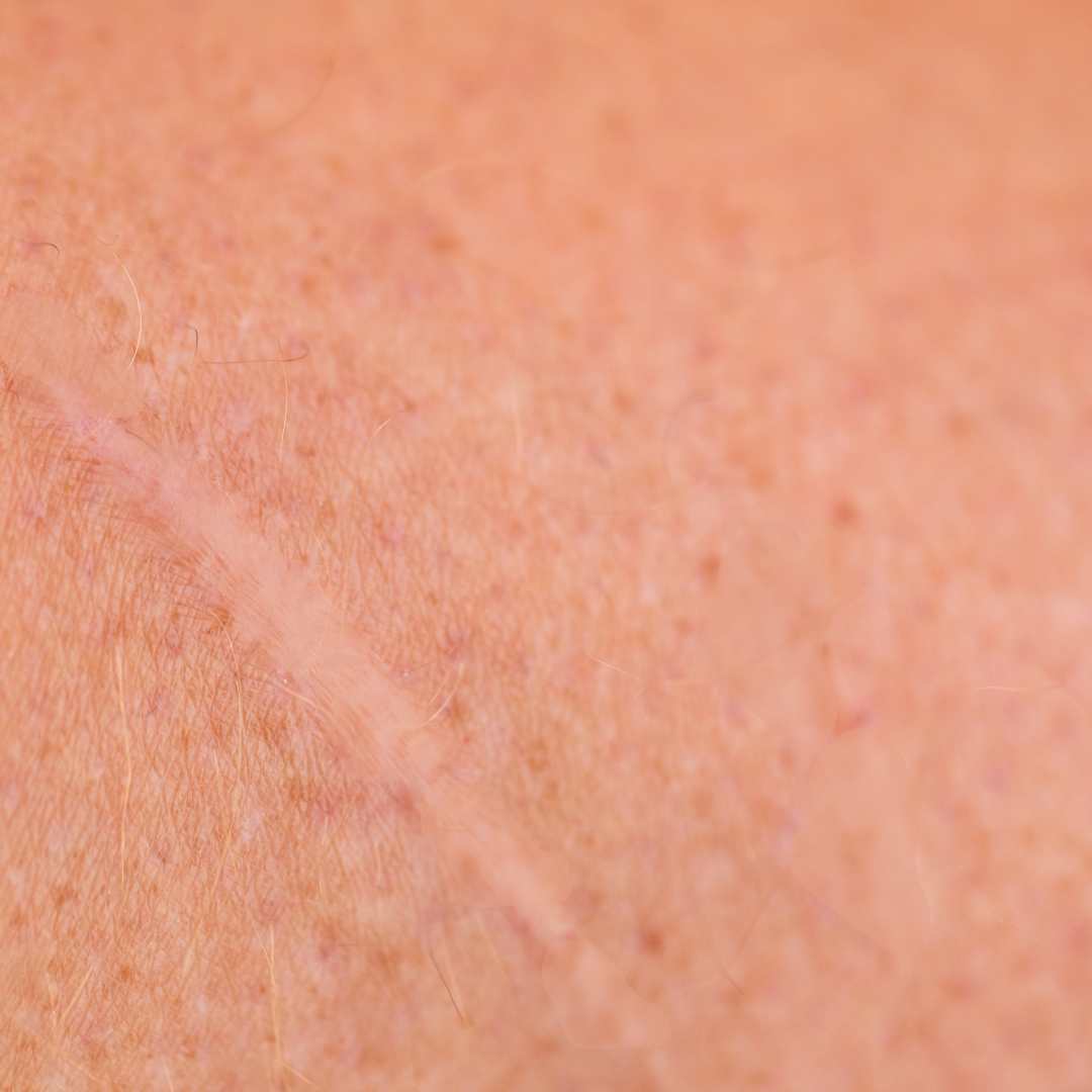 Narbe nach der Permanent Make Up Behadlung weniger sichtbar