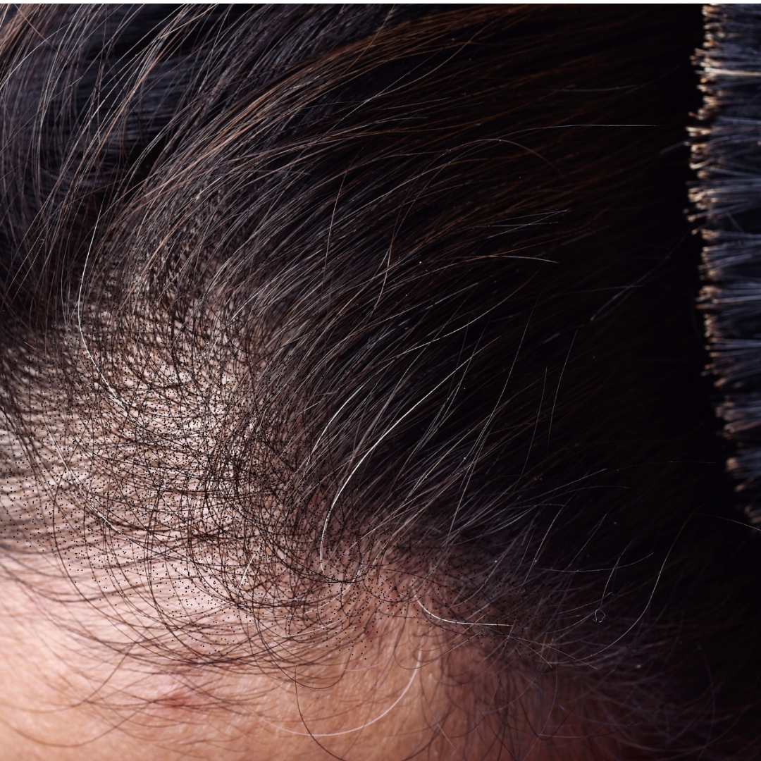 Eine Scalp Kopfhautpigmentierung kann das Selbstbewusstsein verbessen