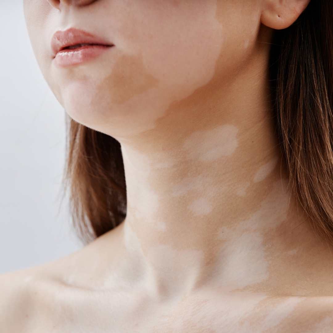 Vitiligo kann man sehr gut mit Permanent Make Up Behandeln und das Hautbild anpassen wie hier bei dieser Kundin am Hals und im Gesicht.