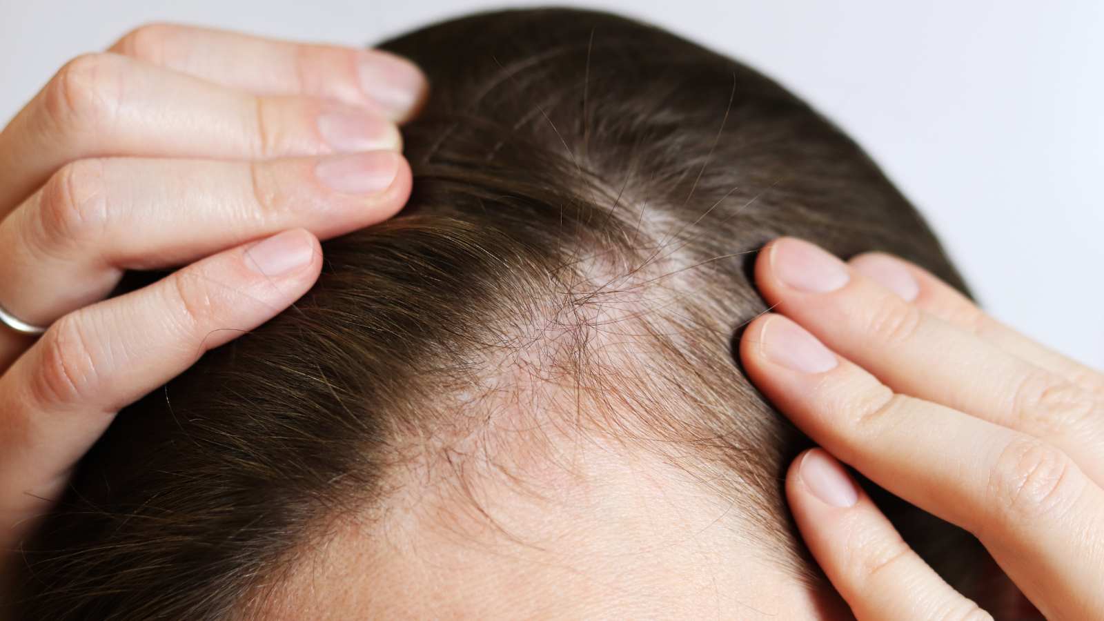 Professionelle Scalp SMP Behandlung in Köln für eine natürliche Haaroptik.